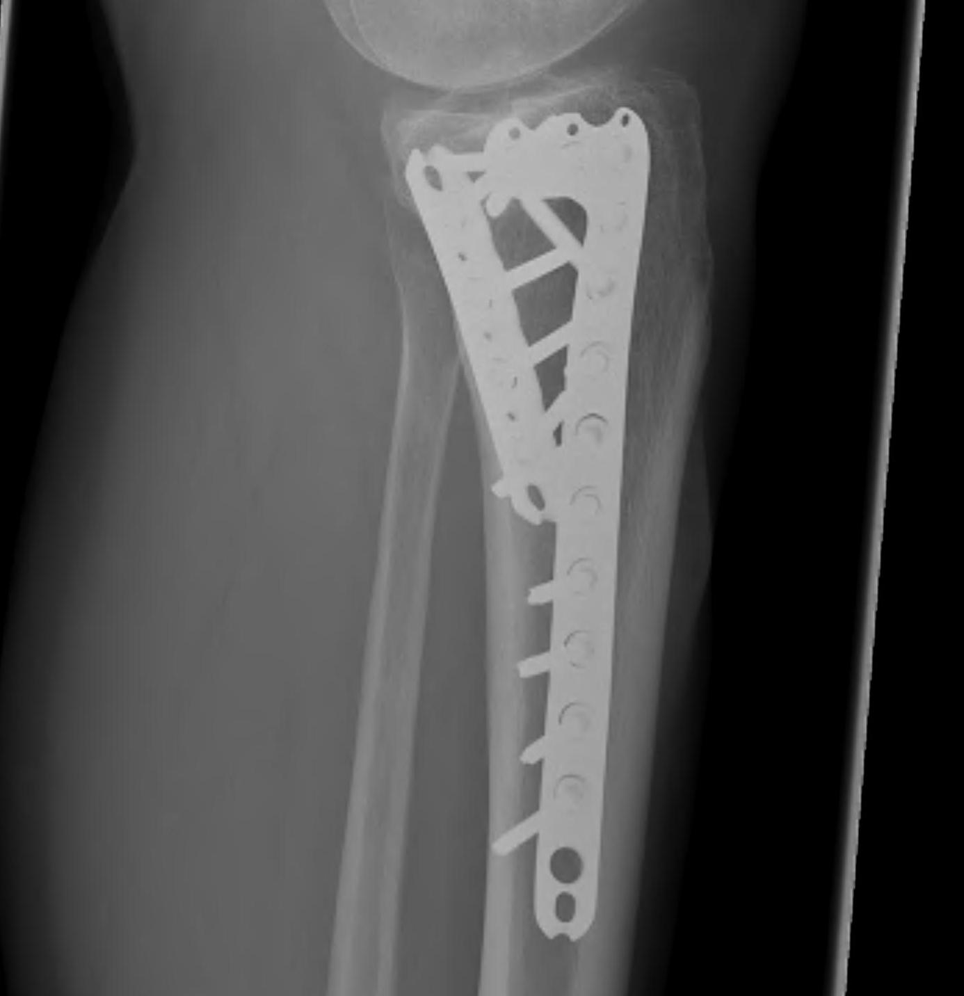 Tibial Plateau Bicondylar ORIF Lateral